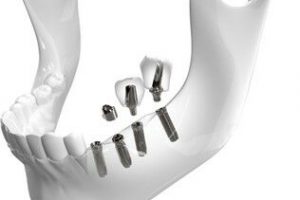 Herstellung von Zahnimplantaten auf CNC- Mehrspindlern